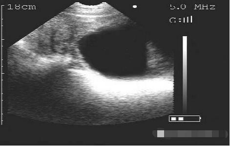 膀胱及卵巢检测图